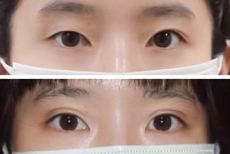 春山クリニック埋没法症例写真