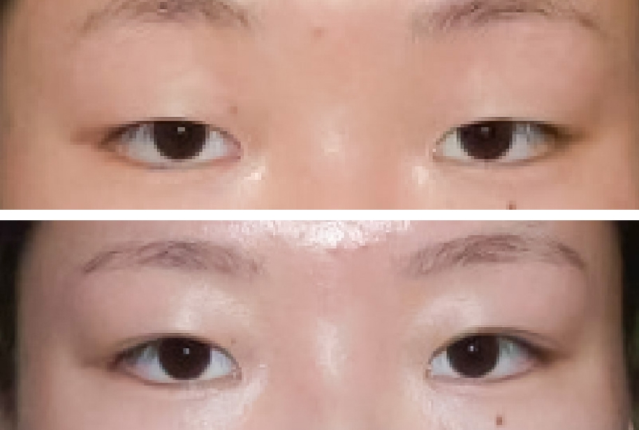 春山クリニック切開法(末広)症例写真