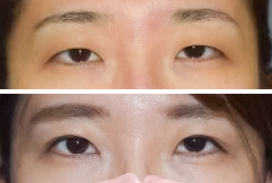 春山クリニック30代挙筋前転法症例写真