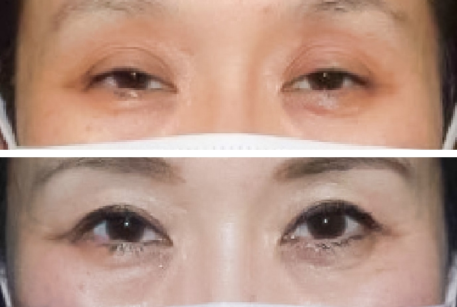 春山クリニック50代挙筋前転法症例写真