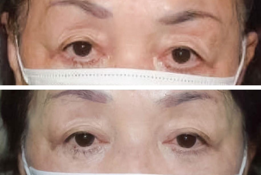 春山クリニック眼瞼下垂 眉毛下皮膚切除症例写真
