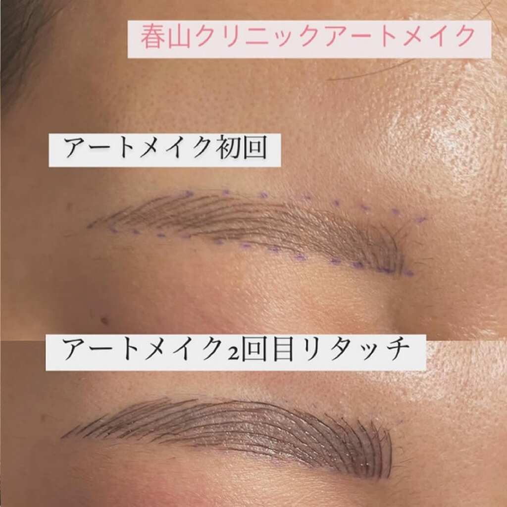 アートメイクの初回と2回目の症例写真