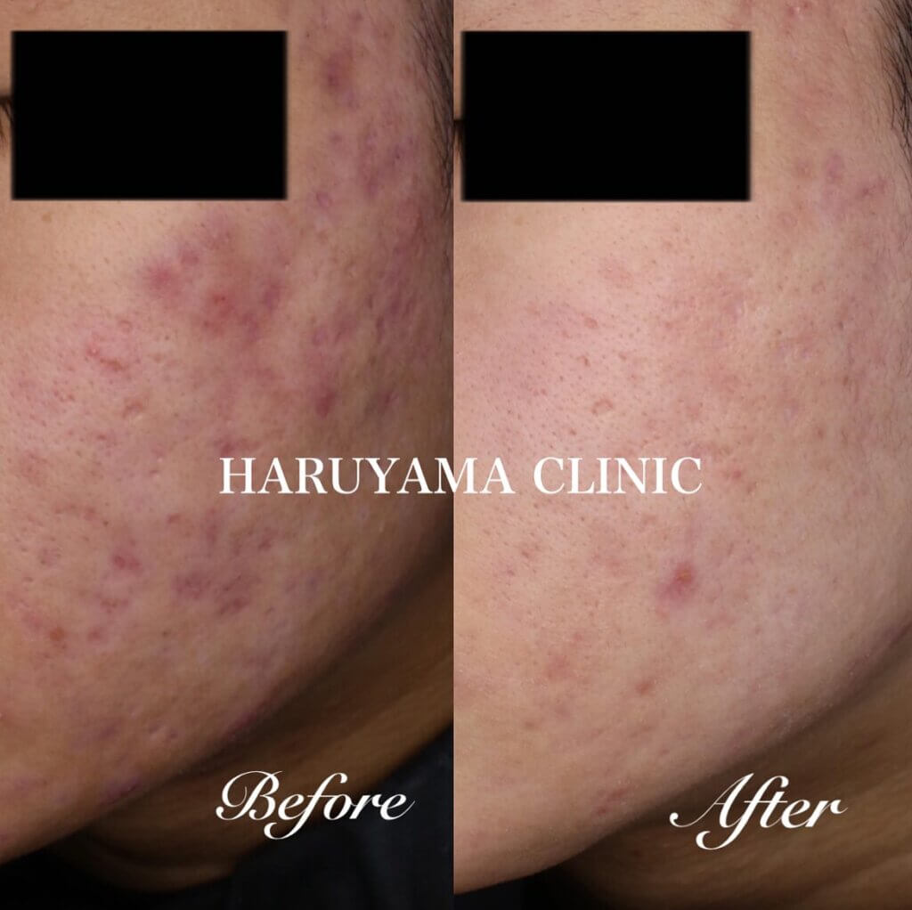 保険の内服と概要を使用した鹿児島のクリニックのニキビ跡の症例