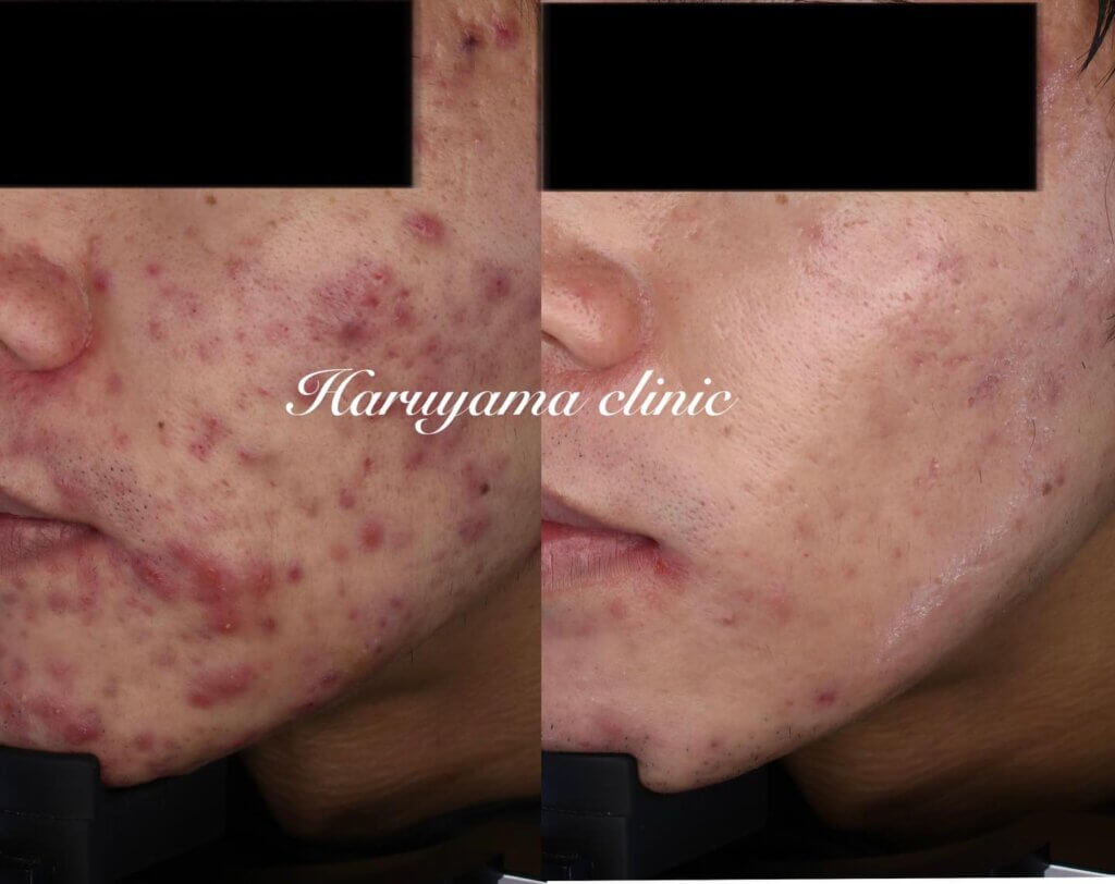 春山クリニックの重度のニキビの症例