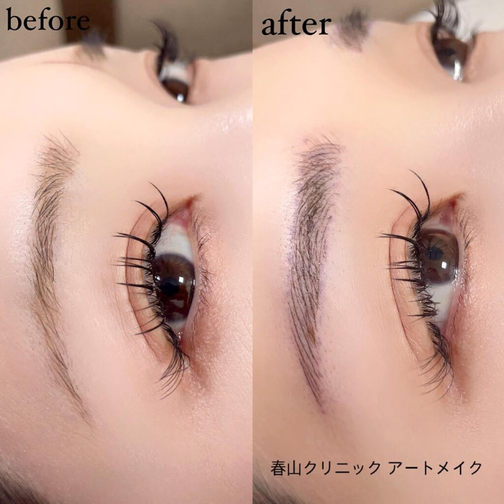 眉毛のアートメイクの症例写真