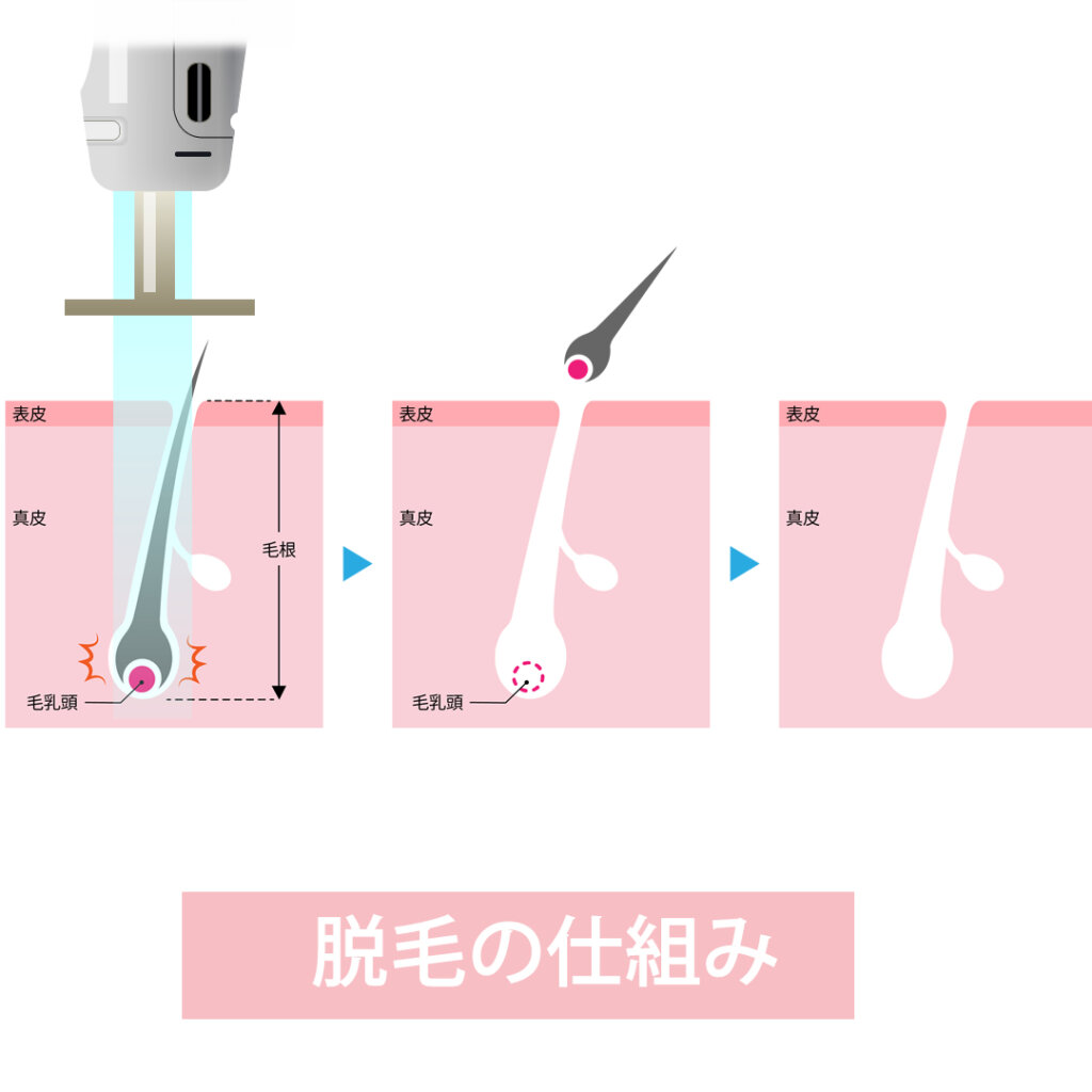 脱毛の仕組み