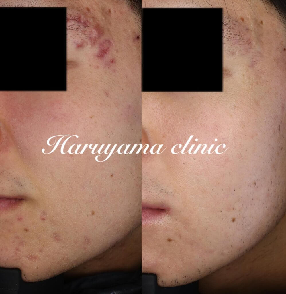 鹿児島でイソトレチノインのみの服用でニキビを治した症例