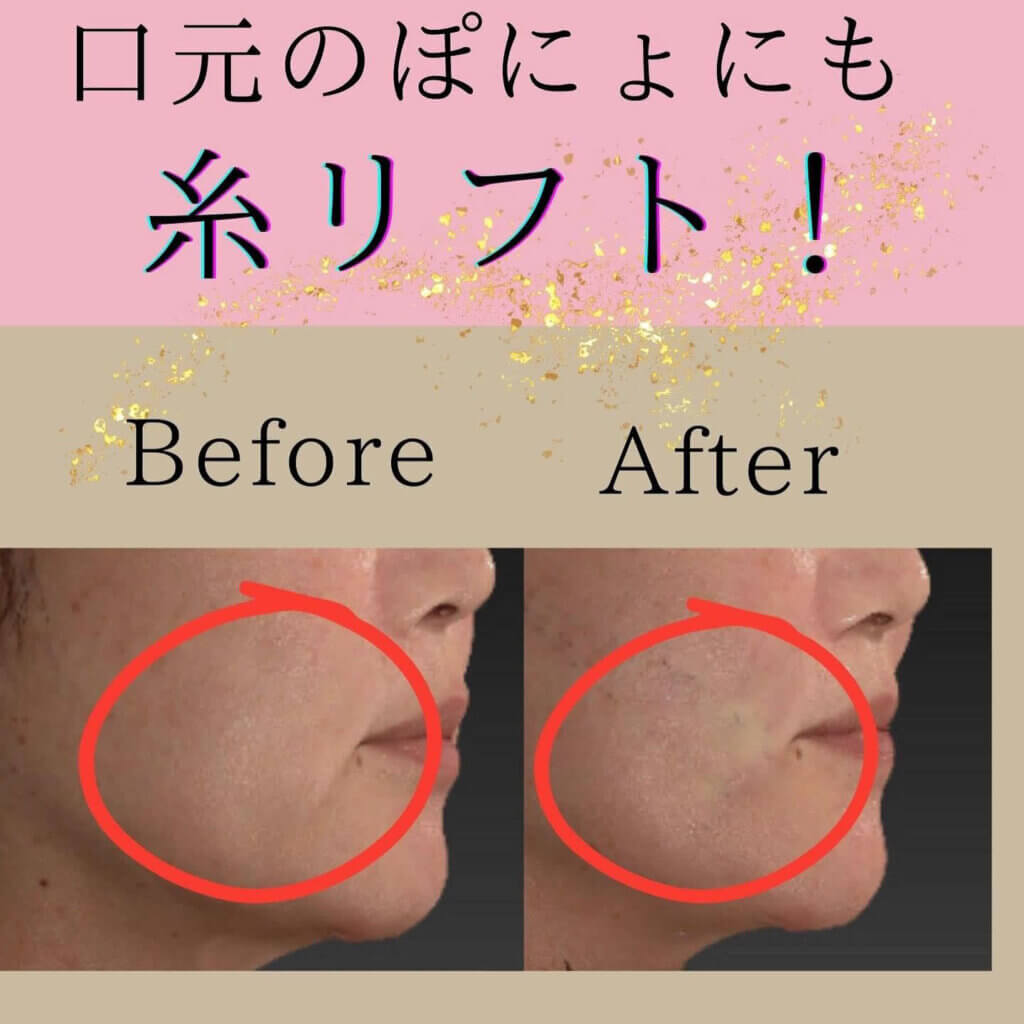 鹿児島で口元のもたつきを糸リフトで改善した症例