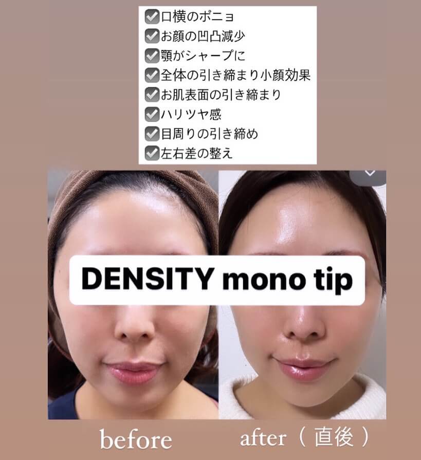 鹿児島のデンシティの症例