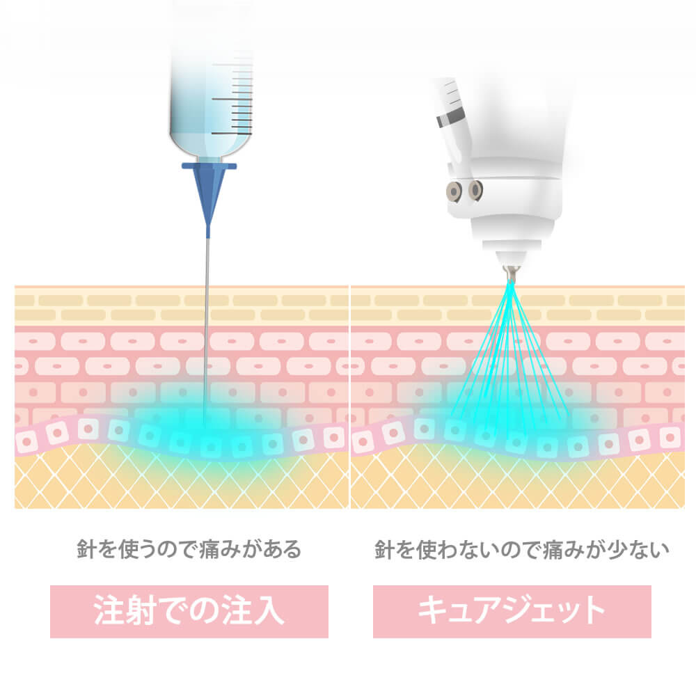 キュアジェットと通常の注入の違い