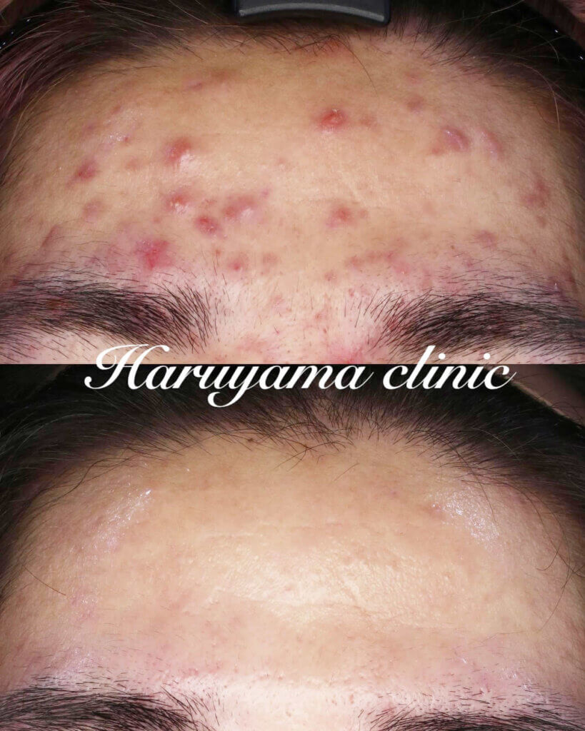 鹿児島でしたニキビ治療の症例写真