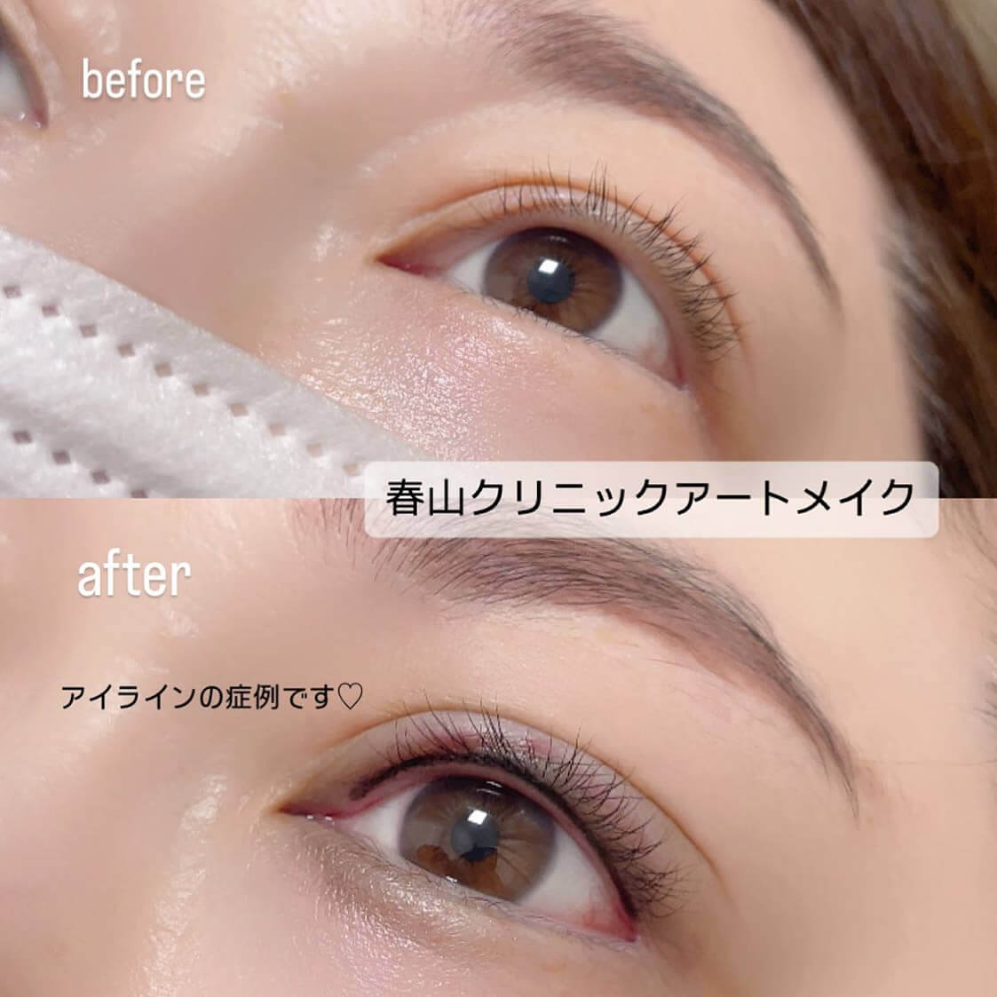 アイラインのアートメイクの症例写真