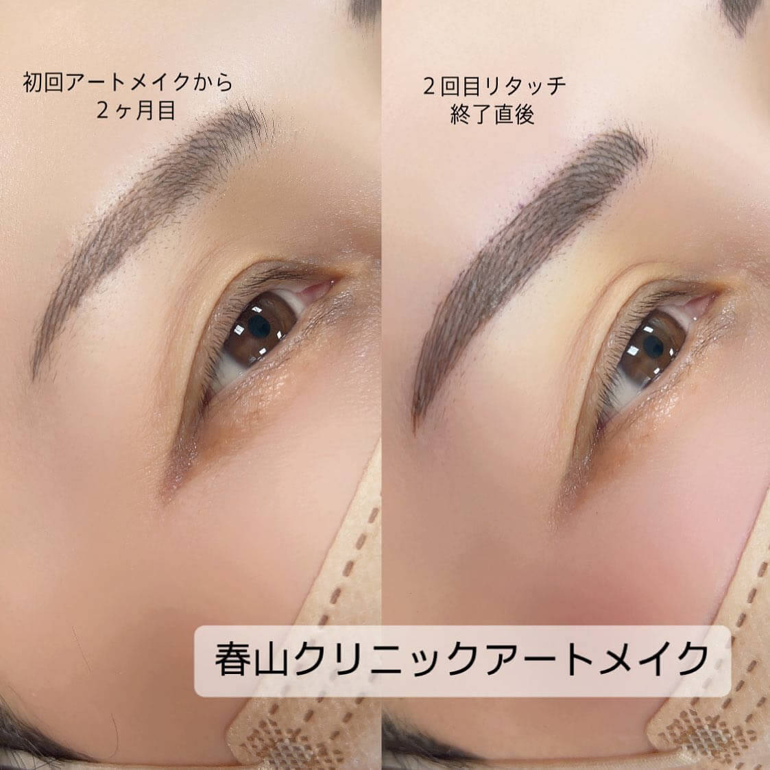 眉のアートメイクの症例写真 (1)