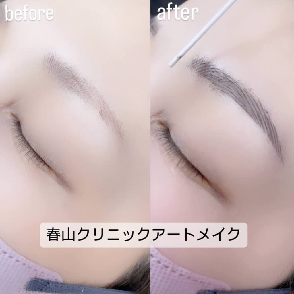眉のアートメイクの症例写真 (10)