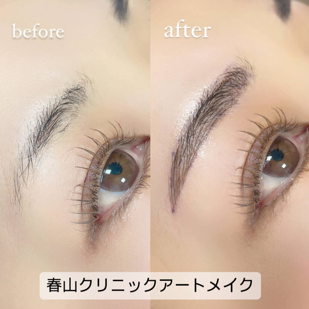 眉のアートメイクの症例写真 (16)