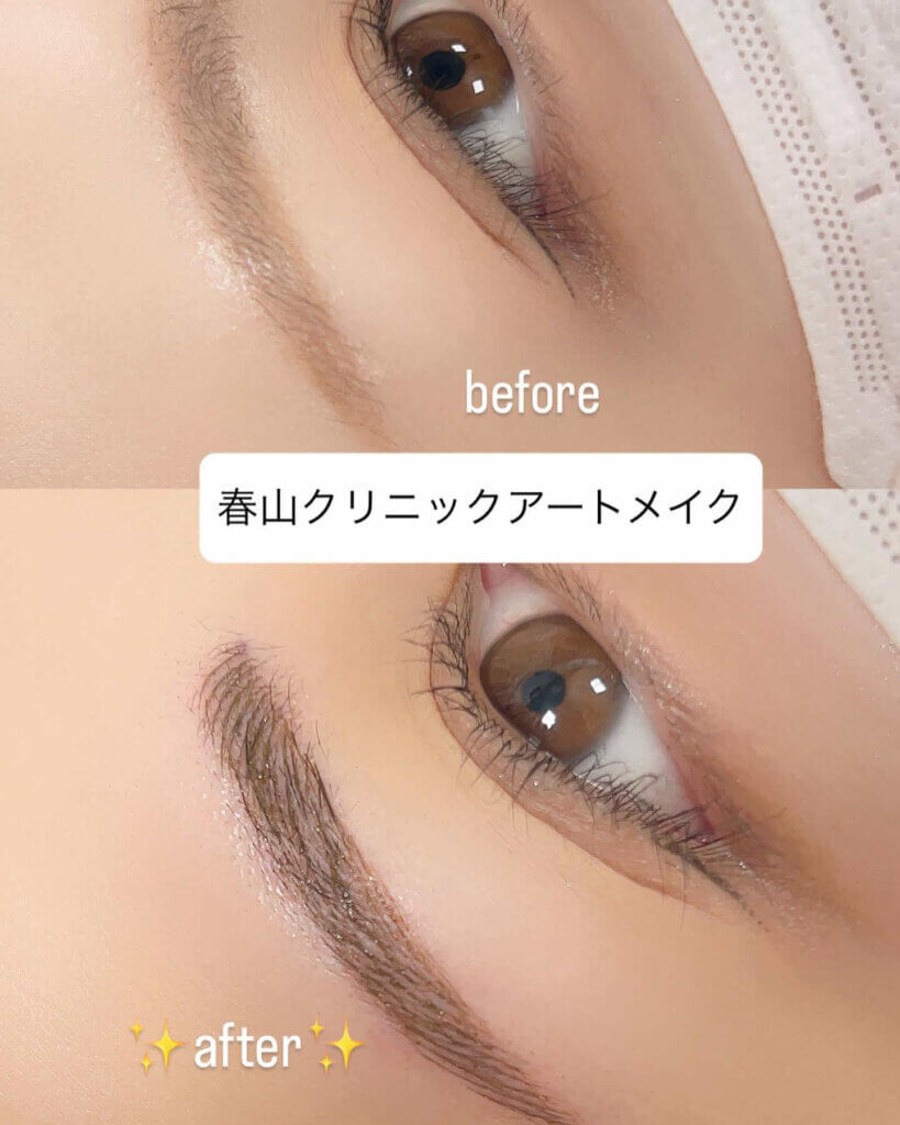 眉のアートメイクの症例写真 (3)