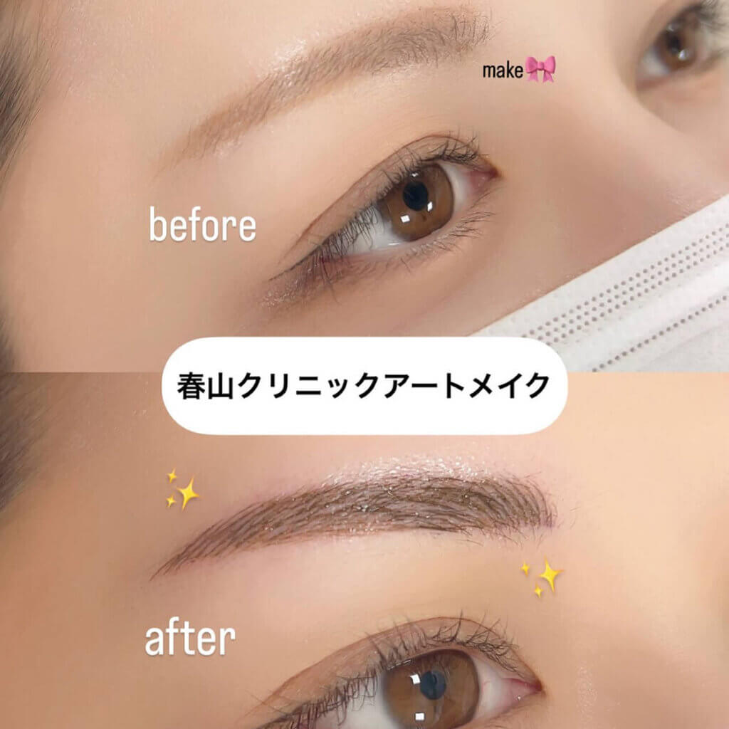 眉のアートメイクの症例写真 (7)