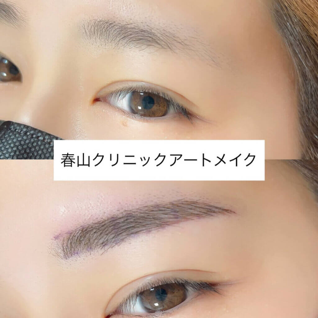 眉のアートメイクの症例写真 (7)