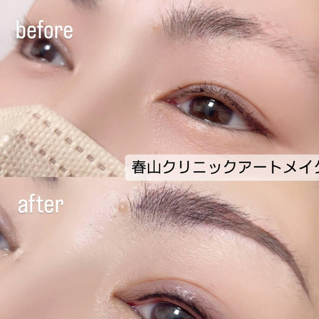 眉のアートメイクの症例写真 (9)