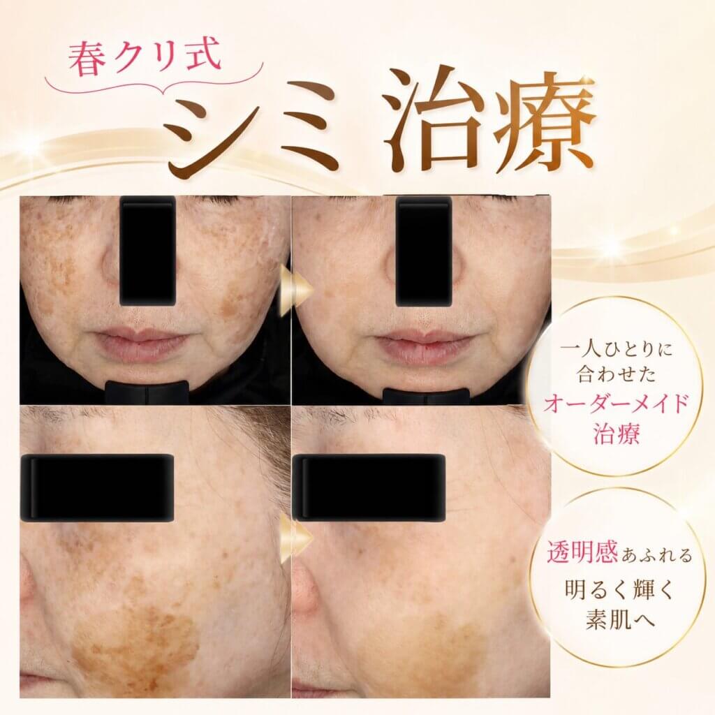 シミ治療の説明 (2)