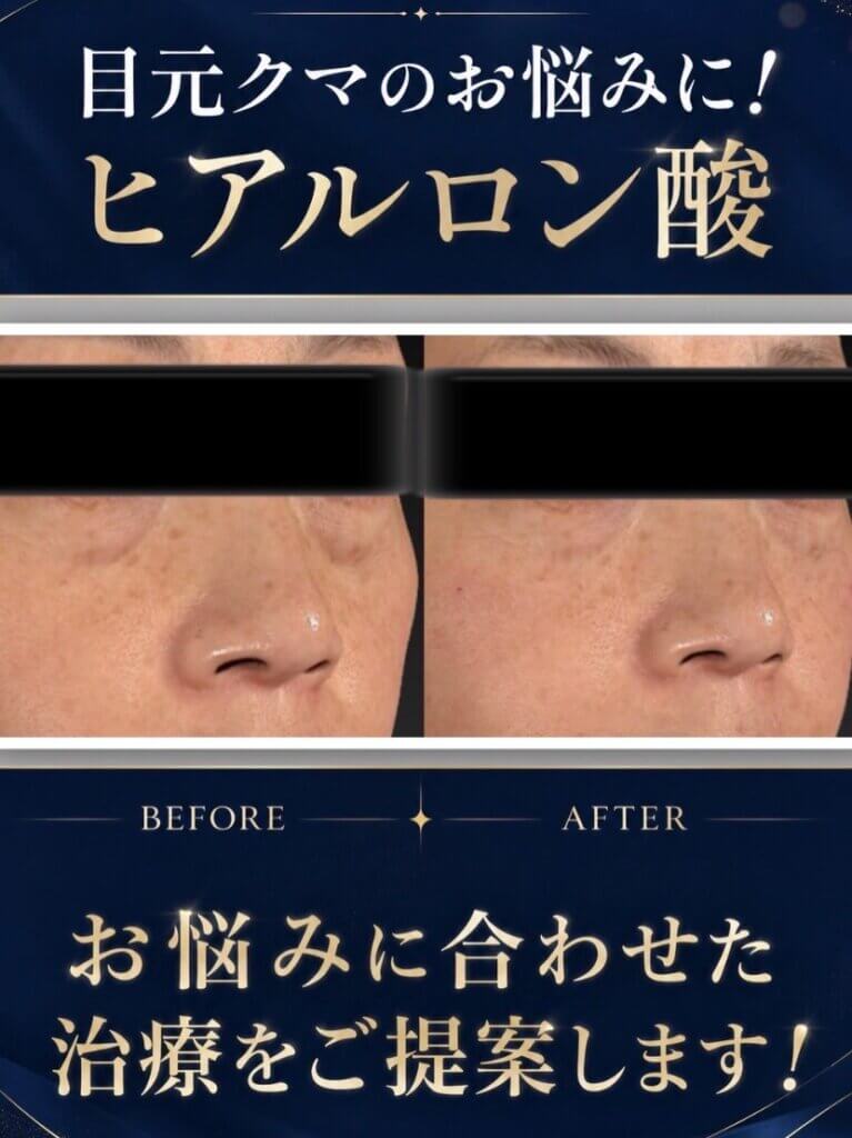 目元のヒアルロン酸の症例