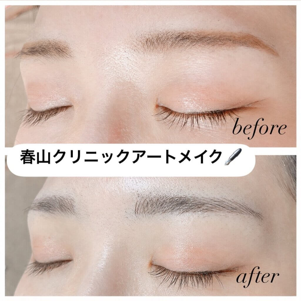 春山クリニックのアートメイク症例写真