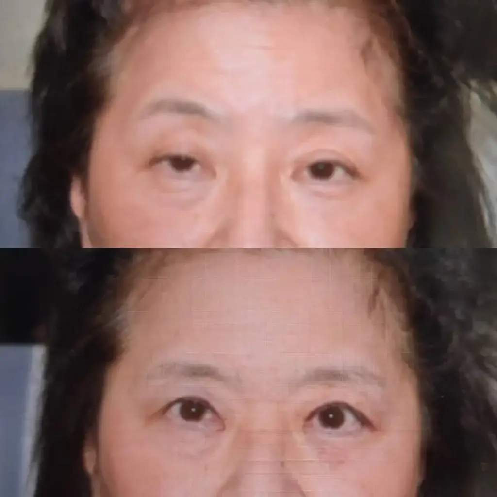 眼瞼下垂の症例写真