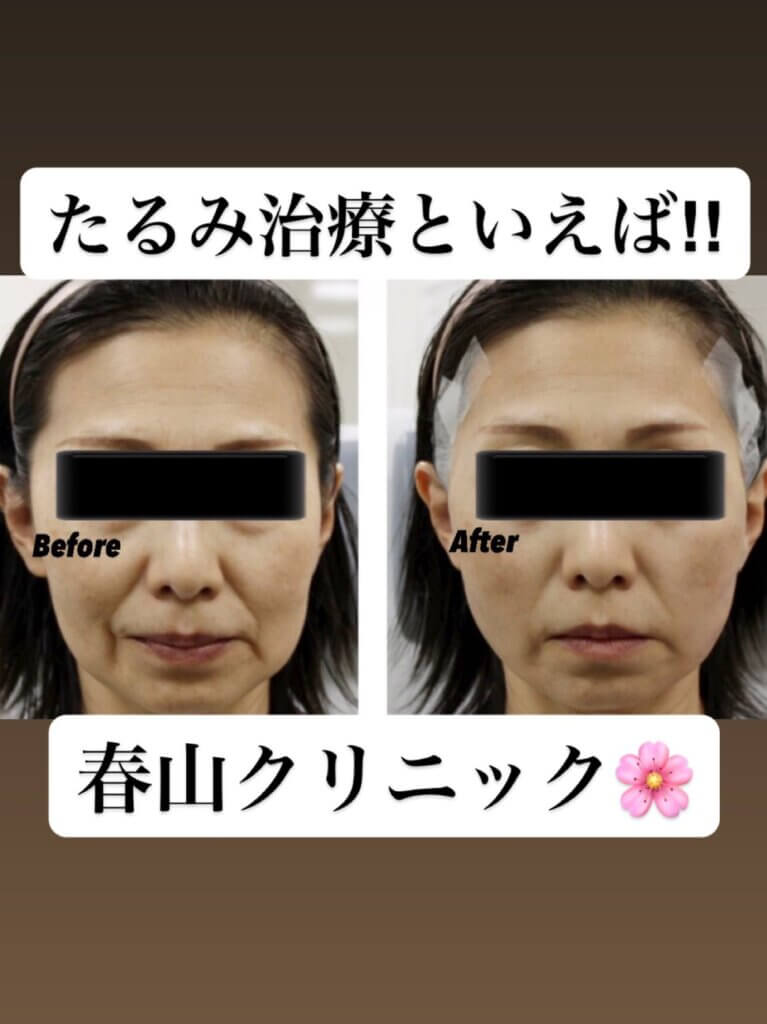 たるみ治療の症例写真 (2)