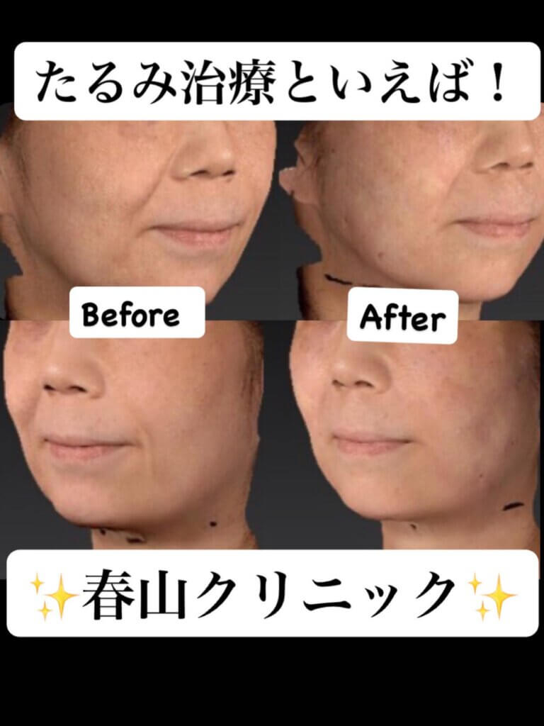 たるみ治療の症例写真