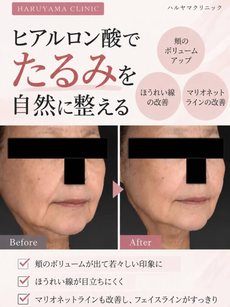 ヒアルロン酸でのたるみ治療の紹介